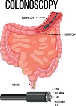 Diagram showing colonoscopy in human vector
