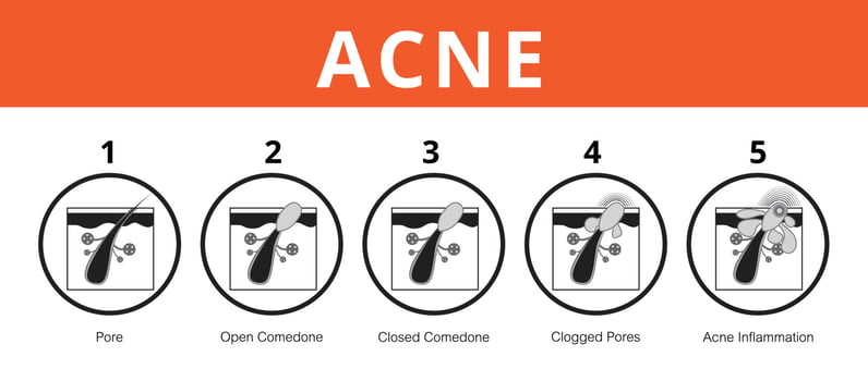 Acne, stages of development, healthy skin, vector design