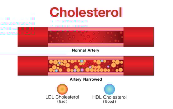 Cholesterol in artery, health risk , vector design