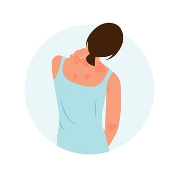 The woman is scratching her back. Allergic itching, skin inflammation, redness and irritation. Atopic dermatitis, eczema, psoriasis, dry skin. Skin problems Concept, isolated, vector. vector