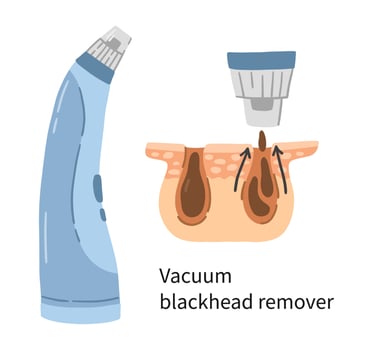 Vacuum blackhead remover vector illustration with layers of dermis and pores. Electric facial device for skin care and washing in a doodle cartoon style. Removal of comedo and dead cells