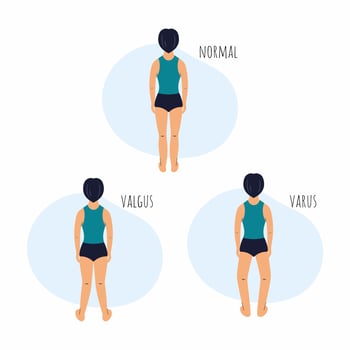 Boy with curvature legs. Health problem. Valgus and varus feet. vector