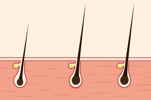 Hair growing concept with a human skin illustration. Hair follicles with oil bags and black threads on the skin. Anatomical Hair growth phase and stages of the hair growth cycle vector. vector