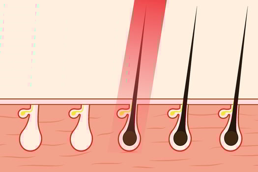 Removing hair with red laser light vector illustration. Removing body hair from the hair root by using laser treatment. Beauty salon works information and hair removal concept vector.