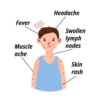 Monkeypox virus symptom infographic on child patient with fever, headache, swollen lymph node, rashes on face, body and back, muscle aches. Vector flat isolated illustration for print.