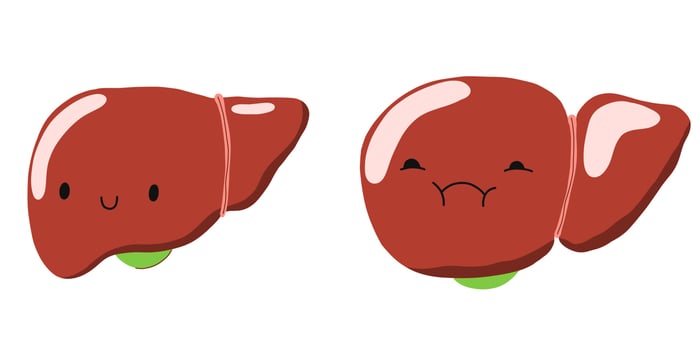 Liver disease. Cirrhosis. Sick and healthy liver character. Hepatomegaly and enlarged organs. Stock vector cartoon illustration on a white background.