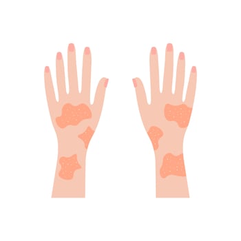 Hands covered with rash. Red psoriatic eruptions and inflamed eczema. Allergic urticaria problems and infectious vector smallpox infection