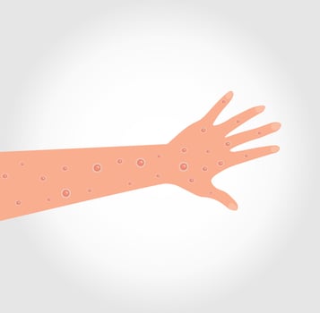 Monkeypox virus. Wounds on the hand and arm. Vectorial vector