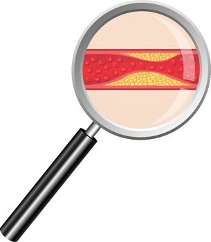 Arteriosclerosis clipart illustration png