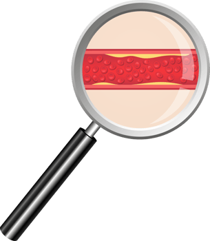 Arteriosclerosis clipart illustration png