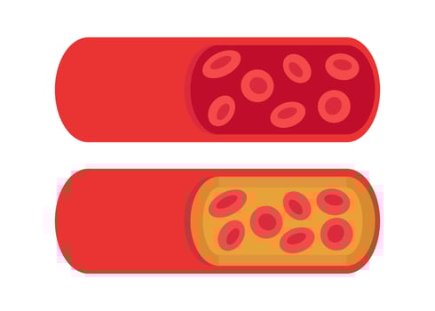 Normal and cholesterol-blocked artery. Blood clot, thrombus, atherosclerotic plaque. Deep vein thrombosis DVT or arterial clot, blood vascular flow. Blocked circulation in blood vessel. Vector