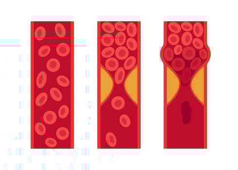 Normal and cholesterol-blocked artery. Blood clot, thrombus, atherosclerotic plaque. Deep vein thrombosis DVT or arterial clot, blood vascular flow. Blocked circulation in blood vessel. Vector