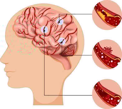 Human with common types of stroke infographic vector