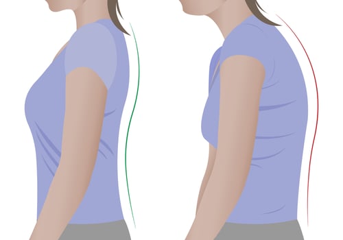 Illustration of a woman's back with a healthy spine and with scoliosis, a bent spine. Vector. vector