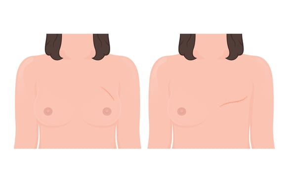 Mastectomy breast cancer lymph node surgery vector
