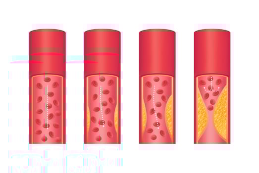 The structure of inside the arteries. Atherosclerosis disease. vector