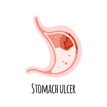The stomach of a person with an ulcer. Gastroenterology. Vector illustration in a flat style.