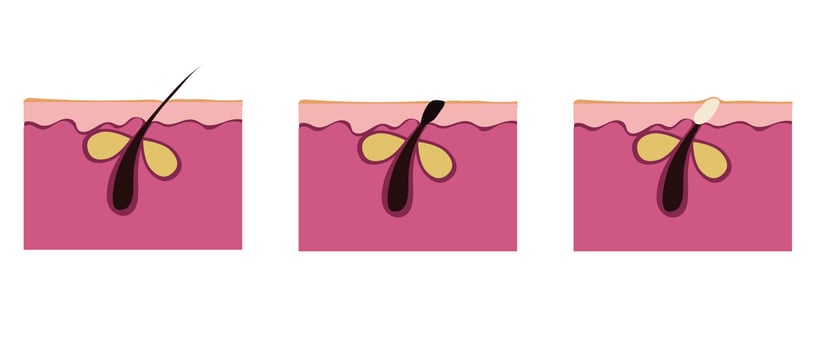 The formation of skin acne, types of inflammation of the hair follicle. Vector illustration isolated on white background.