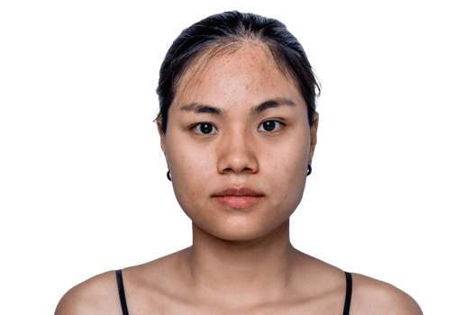 Young Asian woman worry about her face when she has problems with skin on her face in a natural background. Problems with acne and scar on the female skin. Problem skincare and health concept. png