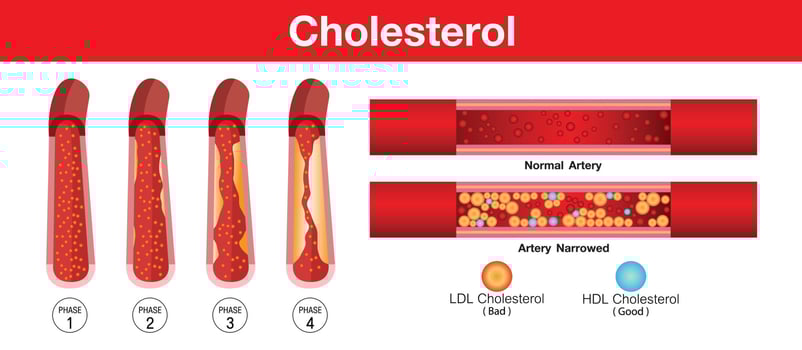 Cholesterol in artery, health risk , vector design
