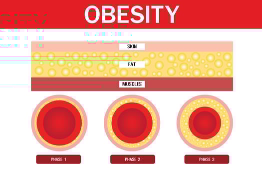 Obesity and overweight, Layers of skin,vector design vector
