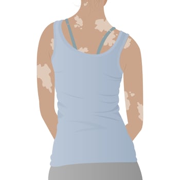 woman with vitiligo on the skin. Beauty diversity concept, positive body, self-acceptance, chronic skin disease awareness, illustration vector