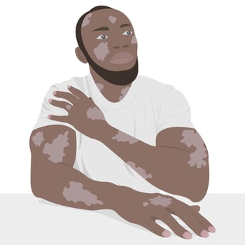 A young African American with vitiligo skin. Beauty diversity concept, positive body, self-acceptance, chronic skin disease awareness. vector