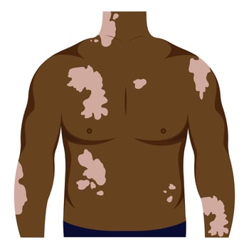 African American with vitiligo on the skin. Beauty diversity concept, positive body, self-acceptance, chronic skin disease awareness, illustration vector