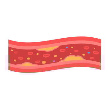 coronary arteries with accumulated fat in the body vector