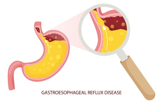 Gastroesophageal reflux disease illustration under magnifying glass vector