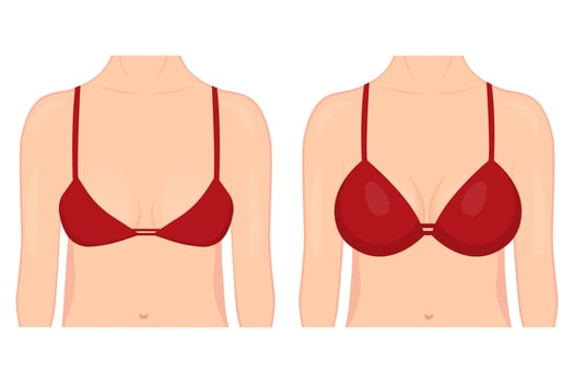 Bust of a woman before and after plastic surgery for breast augmentation. A woman in a bra with different breast sizes on a white background. For advertising and medical publications. vector