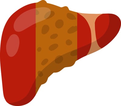 Healthy and diseased liver. Medical element. Biology and education. Health problem. Comparison of two internal organs of a person vector