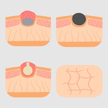 Acne allergies vector inflammation damage scar disease design