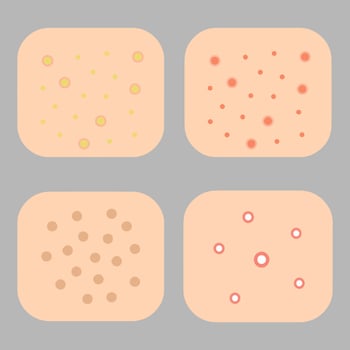 Acne allergies vector inflammation damage scar disease design