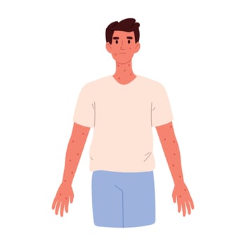 Rash on the skin. Autoimmune disease, chickenpox, atopic dermatitis. Rash on the man. Flat vector illustration