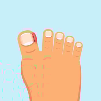 ingrown nail. onychocryptosis. nail disease, flat vector illustration