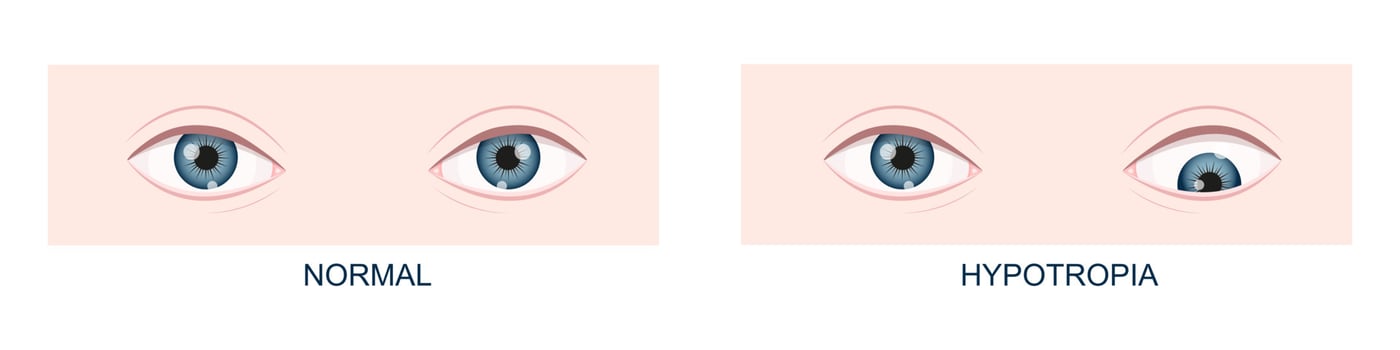 Hypotropia. Vertical strabismus. Human eyes healthy and with downward gaze position. Double vision vector