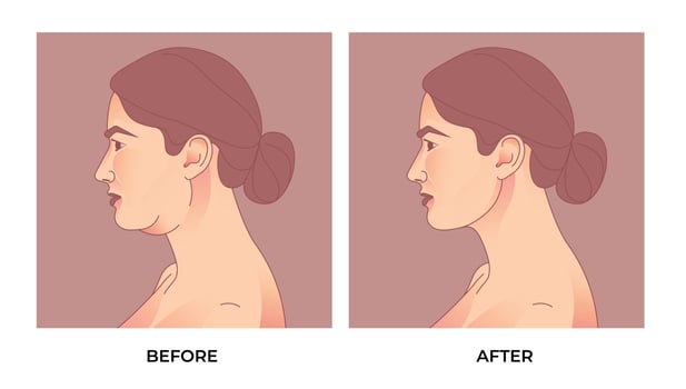 Double Chin Liposuction. before and after  Brachioplasty, liposuction or plastic surgery, woman body shape transformation, Fat To Fit. vector