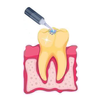 Trendy Root Canal vector