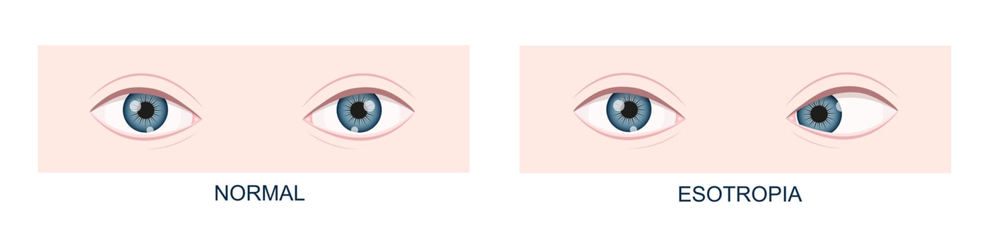 Esotropia. Horizontal strabismus before and after surgery. Eye misalignment, cross-eyed condition. Human eyes healthy and with inward gaze position. Double vision vector