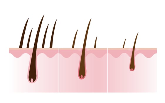 Step of hair loss vector illustration isolated on white background.