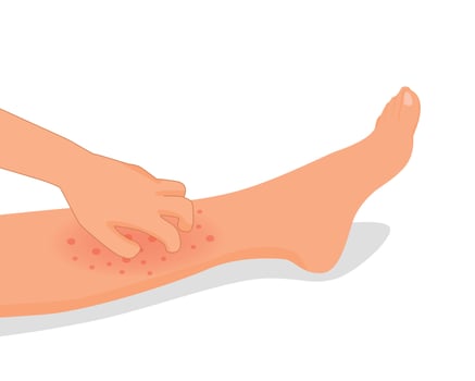 Woman hand scratching her itchy leg with rash dry skin because of allergic reaction vector