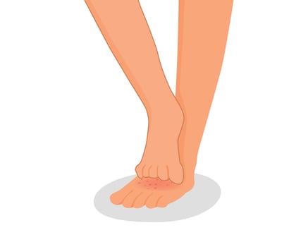 human leg scratching itchy foot with rash dry skin because of allergic reaction vector