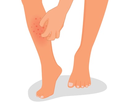 Man hand scratching his itchy leg with rash dry skin because of allergic reaction vector