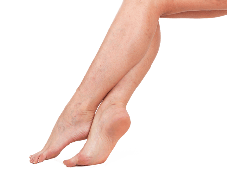 Legs of a woman. Skin with vascular stars. png