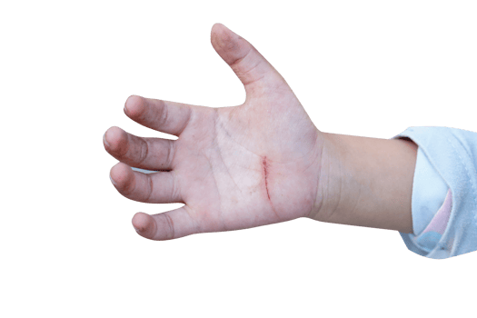 wound on a child's hand png