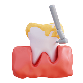 3d illustration of cleaning tartar with a dental drill png