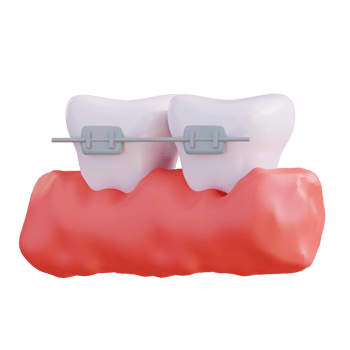 3d illustration of wearing braces png