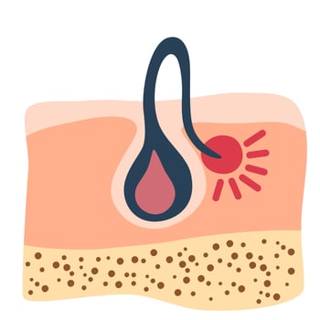 Ingrown hair. Inflammation, skin problems. Anatomy infographics of hair. Vector illustration isolated on the white background.