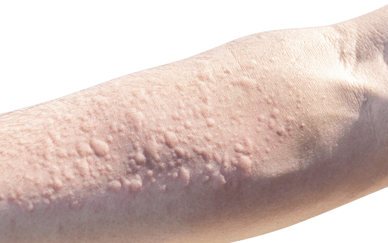 Allergic reaction to dust on arm png